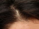 How To Treat Scar Tissue In Scalp?