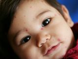 Foods To Avoid When You Have Chicken Pox