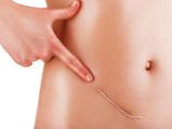 Beware Of These Dangers Of Liposuction