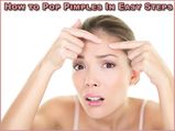 How To Pop Pimples In Easy Steps