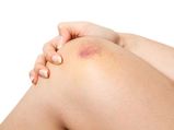 Reasons Why You Get Bruised Easily