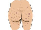 Home Remedies For Acne And Boils On The Buttocks 