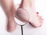 8 Remedies To Have Cracked Free Feet