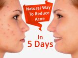 Try This Simple Natural Face Pack To Reduce Acne In 5 Days! 