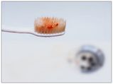 Weird Reasons Why Your Gums Are Bleeding
