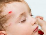 Childhood Head Injury May Up Mental Illness, Mortality Risk