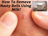 How To Remove Nasty Boils Using Milk?