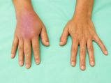 Tips To Get Rid Of Swelling 