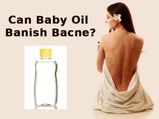 Can Baby Oil Banish “Bacne”?