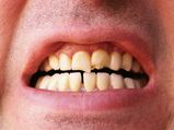 Effects Of Fluoride-Treated Water On The Teeth