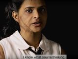 This Brave Acid Victim Sends Out Her Video CV On Social Sites