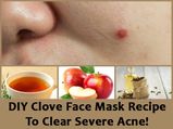 DIY Clove Face Mask Recipe To Clear Severe Acne!