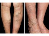 Magical Home Remedy To Reduce Varicose Veins In A Month