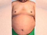 Shocking Facts On Gynecomastia (Male Breasts)! 