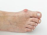 Effective Solutions For Bunion Pain, That Actually Works