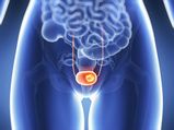 Symptoms Of Bladder Cancer Every Woman Should Know