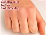  ­Easy Home Remedies To Treat Dark Knuckles