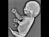 Her Foetus Looked Like A Mermaid!