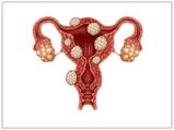 Does Pregnancy Cause Uterine Fibroids?