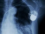 60 Year Old Gets The Smallest Pacemaker Implant