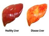 Foods To Eat And Avoid In A Liver Cirrhosis Patient's Diet