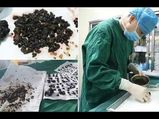 Most Bizarre Things Doctors Have Removed From Humans; #3 Is Shocking!