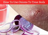 Here Is How You Can Use Onions To Treat Boils 