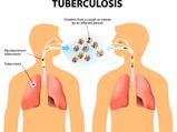 Scientists To Develop Effective TB Vaccine