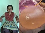 Girl Had A Tapeworm Cyst, Which Was Half The Size Of Her Brain, Removed!