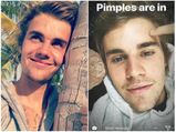 Justin Bieber Breaks All Fashion Trends, Says Pimples Are In!