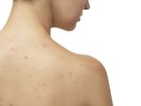 Home Remedies To Treat Shoulder Acne
