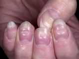 How To Remove White Spots From Fingernails?
