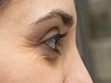 How To Remove Wrinkles On The Outer Corner Of The Eyes?