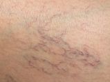 How To Get Rid Of Spider Veins Naturally
