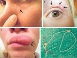 Doctors Remove Live Worm Crawling Under A Woman’s Face!