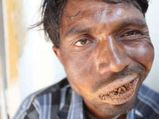 Man Who Eats 3 Kg Of Mud, Rocks And A Brick Every Day