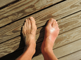 What Is Gout And How It Can Be Treated?