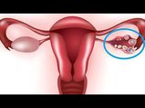 Ovarian Cysts: Causes, Symptoms, Diagnosis & Treatment