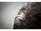 Poliosis (White Hair Patch): Symptoms, Causes And Treatment 