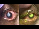 Her Cornea Was Eaten Away By Bacteria As She Slept With Contact Lenses In