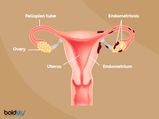 Endometriosis: Causes, Symptoms, Diagnosis & Treatment