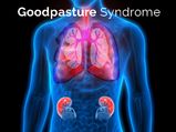 Goodpasture Syndrome (GPS): Causes, Symptoms, Diagnosis And Treatment 