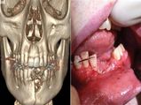 A Vape Pen Explodes And Shatters Teen's Teeth