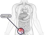 Appendicitis: Causes, Symptoms, Diagnosis & Treatment