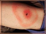  Lyme Disease: Symptoms, Causes, Diagnosis And Treatment