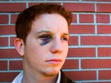 Black Eye: Causes, Symptoms, Diagnosis & Treatment