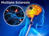 Multiple Sclerosis: Causes, Symptoms, Diagnosis And Treatment