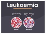 Leukaemia : Causes, Symptoms, Diagnosis, Prevention And Treatment  