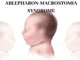 Ablepharon-macrostomia Syndrome: Causes, Symptoms, Diagnosis And Treatment