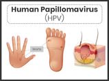 Human Papillomavirus (HPV) Infection: Symptoms, Causes, Risk Factors, Treatment And Prevention